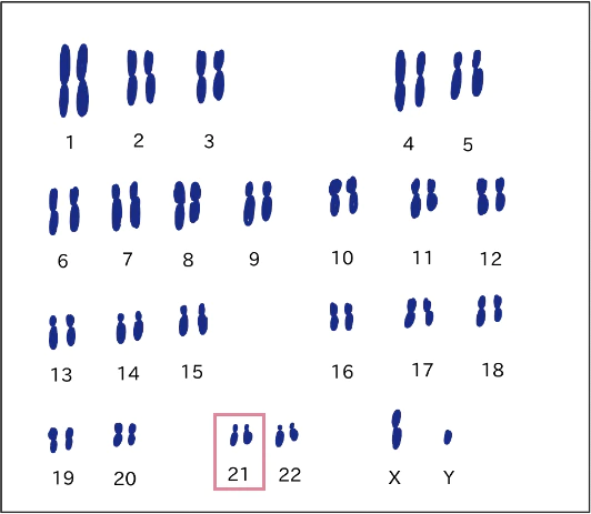 21trisomyの染色体イメージ