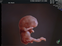 超初期の赤ちゃんの超音波画像